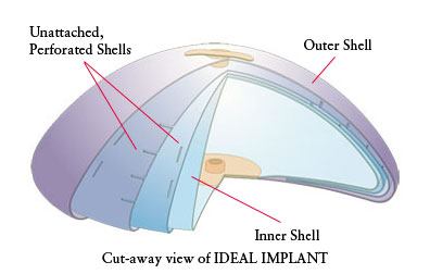 Breast Implants in Ft. Lauderdale, FL